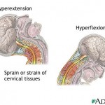 arteries beauty parlor stroke hyperextension
