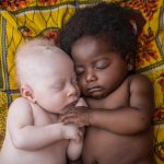 3 weeks-old newborn with albinism happily sleeping with his cousin in Kinshasa