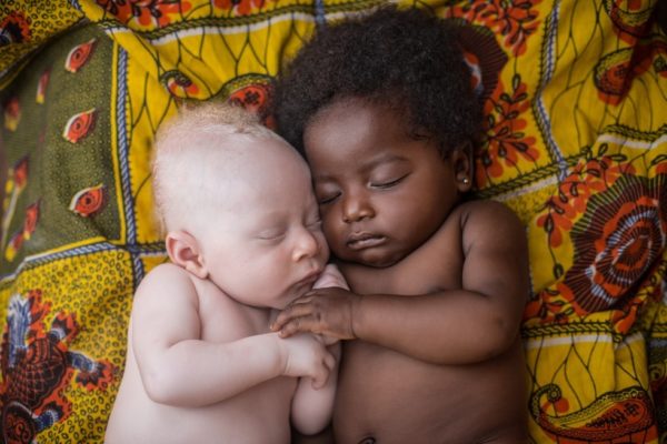 3 weeks-old newborn with albinism happily sleeping with his cousin in Kinshasa