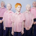 Blind albino boys.