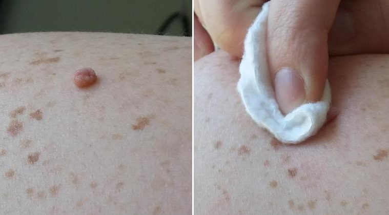Rub THIS Natural Ingredient On Your Skin Tags And They Will Disappear In NO TIME!