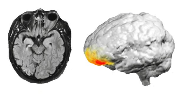 scientists-make-a-surprising-discovery-from-an-epilepsy-patient