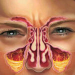 Kill Sinus Infection Within Minutes, With What You Have In Your Kitchen!