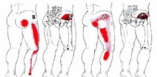 Sciatica Back Pain Remedy