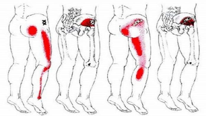 Sciatica Back Pain Remedy