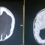 Remember-The-Boy-Who-Was-Born-With-Almost-No-Brain-2