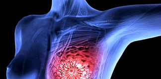 Scientists Amsterdam Destroyed Breast Cancer Tumors