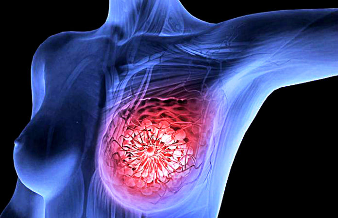 Scientists Amsterdam Destroyed Breast Cancer Tumors