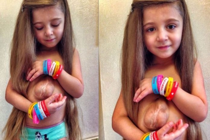 Girl Born With Heart Outside