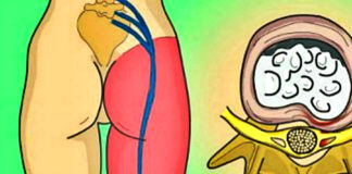 Release The Pinched Nerve In The Lumbar Area (sciatica) – 2 Simple Ways To Get Rid Of The Pain… How to Release the Pinched Nerve in the Lumbar Area