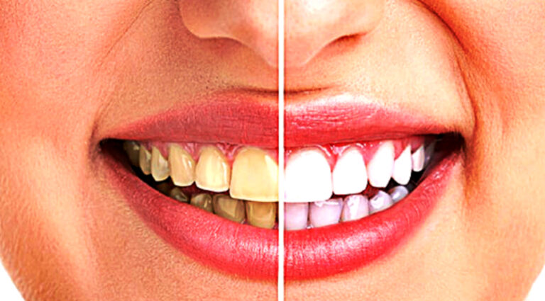 how-to-improve-your-smile-and-get-confidence