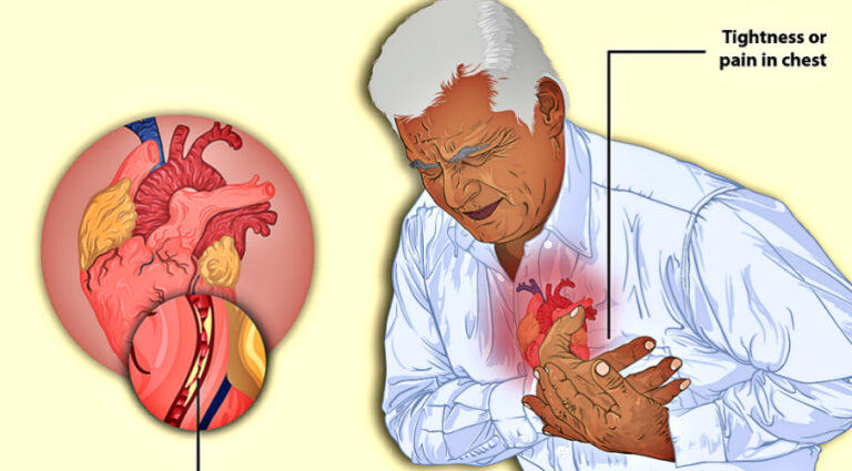 how-to-prevent-a-sudden-cardiac-arrest-in-the-workplace