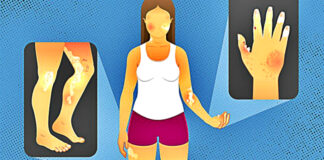 things-you-should-know-about-scleroderma