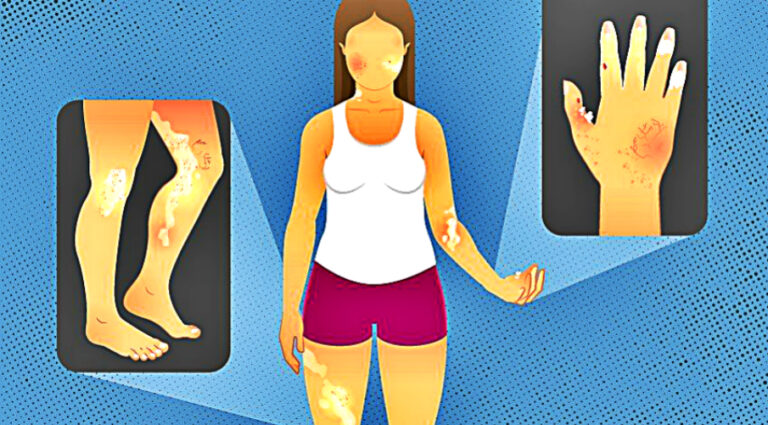 things-you-should-know-about-scleroderma