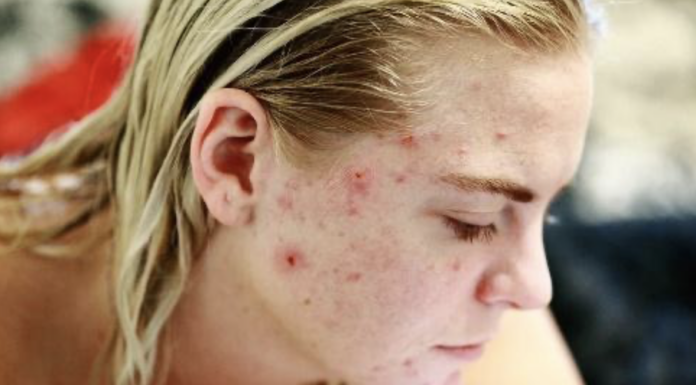 advice-for-consistently-irritated-skin