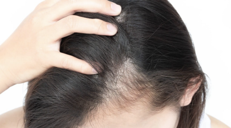 short-guide-to-hair-loss