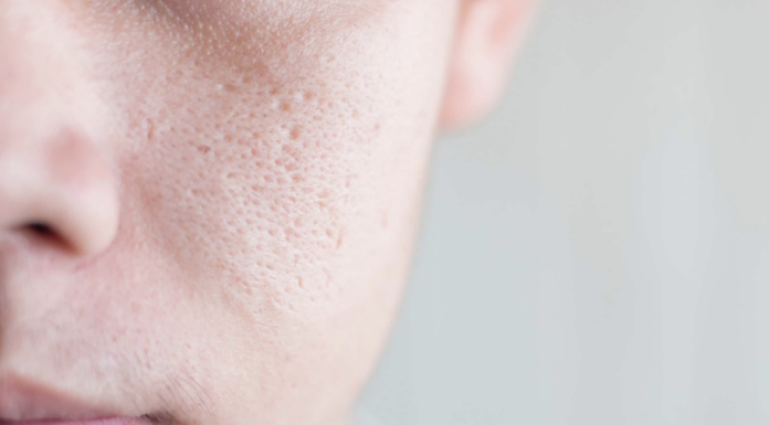 6 Ways How to Shrink Your Pores Naturally how-to-shrink-your-pores-naturally