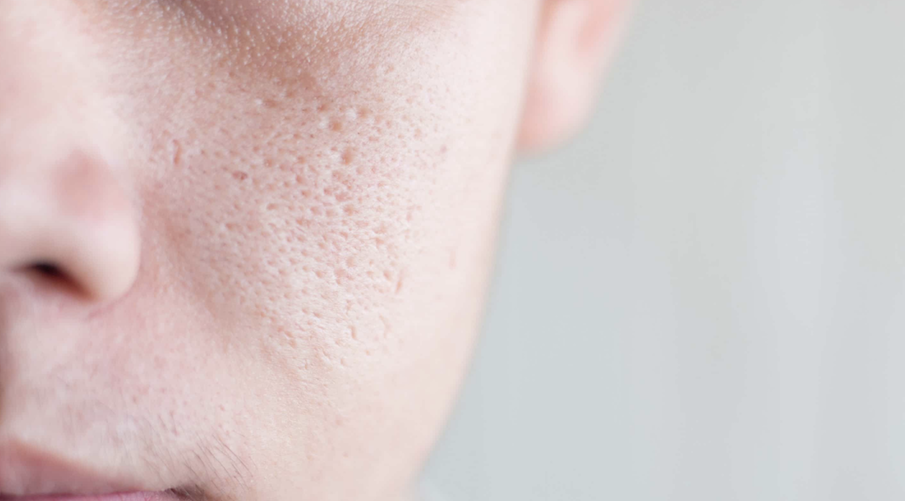 how-to-shrink-your-pores-naturally