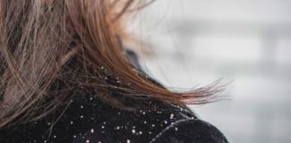 how-dandruff-can-ruin-your-hair