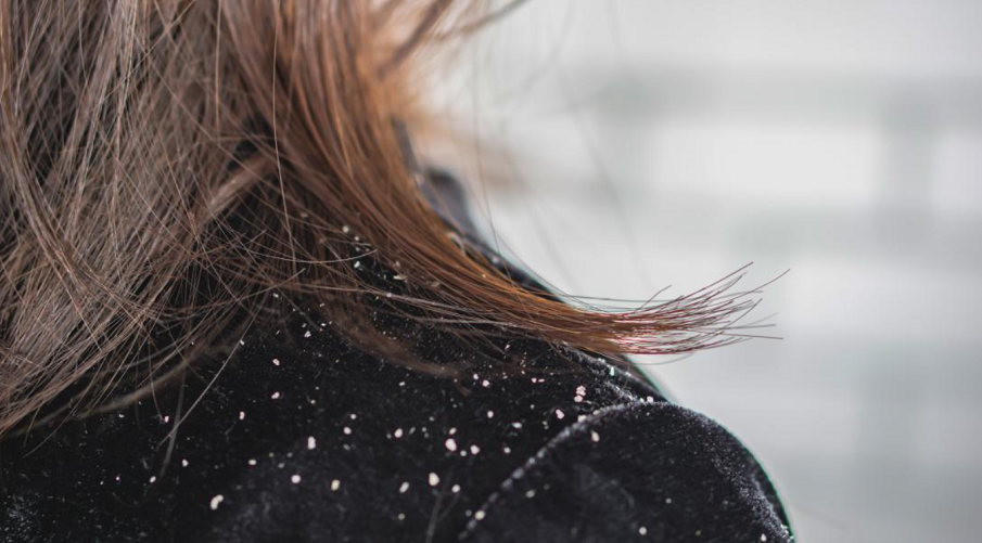 how-dandruff-can-ruin-your-hair